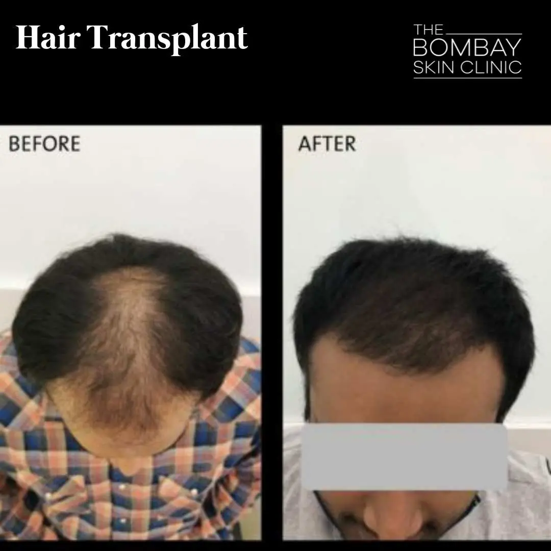 Before After
