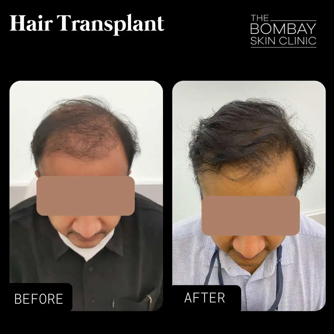 Before After